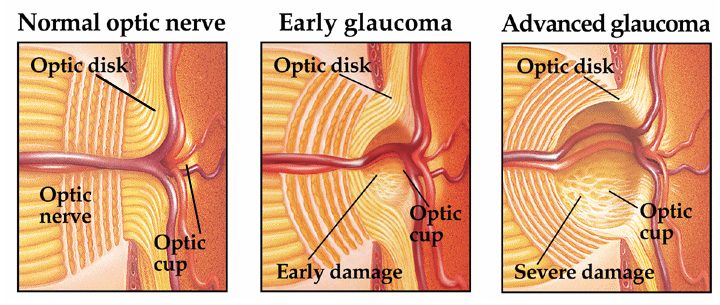 Efectos del glaucoma